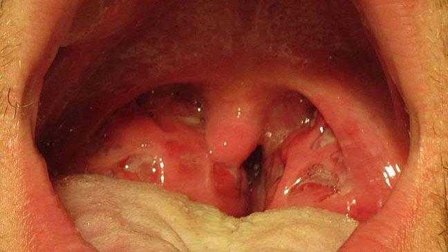 Strep throat symptoms for adults