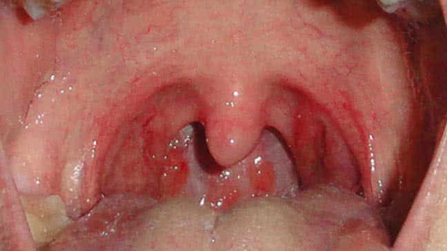 Wizard reccomend Strep throat symptoms for adults