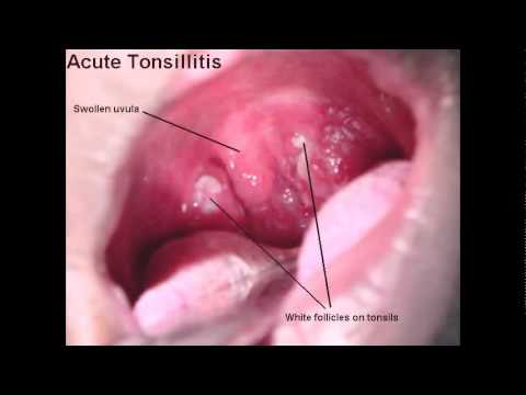 best of Adults Strep throat symptoms for